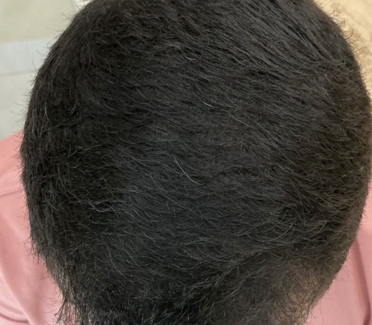 Depois do Fotona Capilar — caso 1