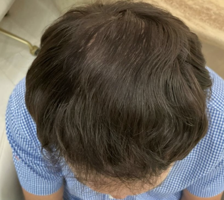Depois do Fotona Capilar — caso 2